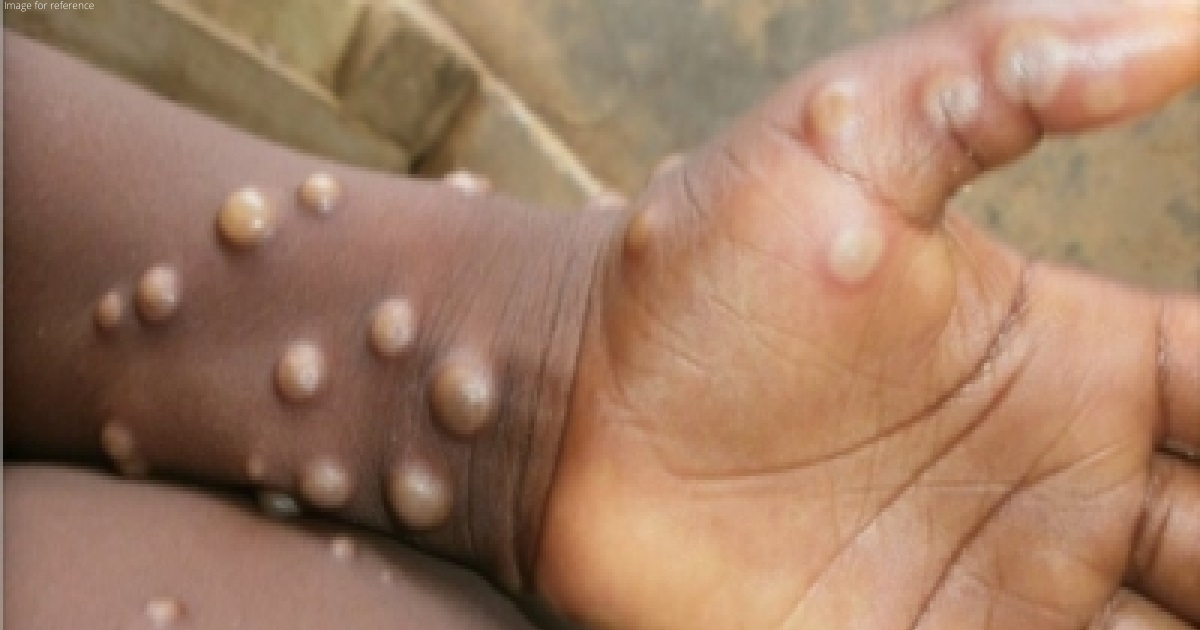 2 suspected cases of Monkeypox in Raj